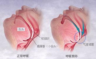 冬季应加倍警惕夜间睡觉打呼噜