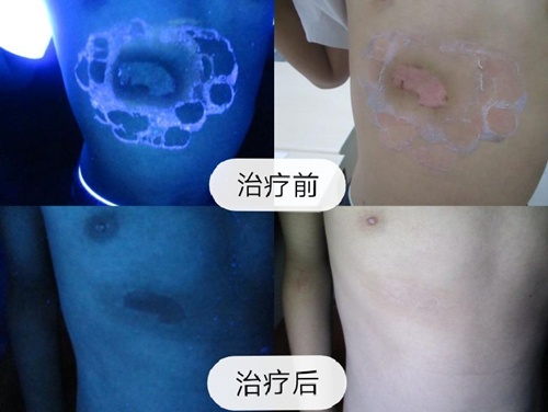 武汉环亚白癜风医院:北京高级专家公益门诊暨白癜风公益大筛查 3.jpg
